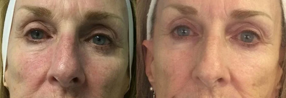 Anti-Aging Effects