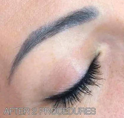 After 2 procedures.jpg
