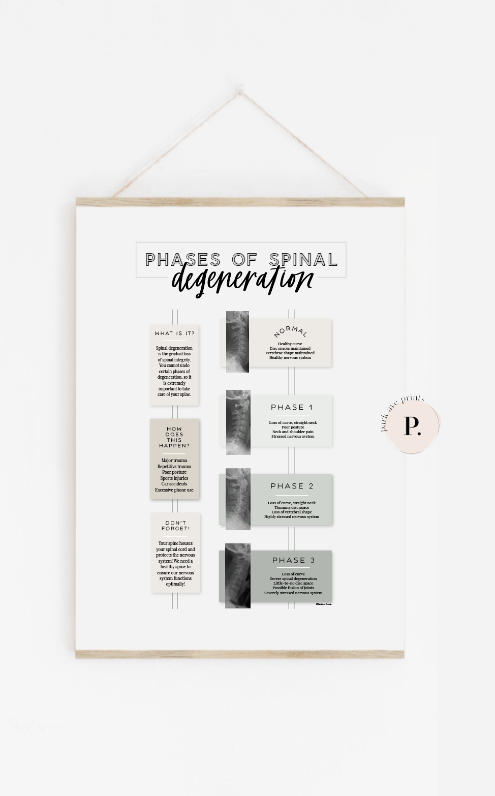 NEW! Spinal Degeneration Poster (Frame NOT included)