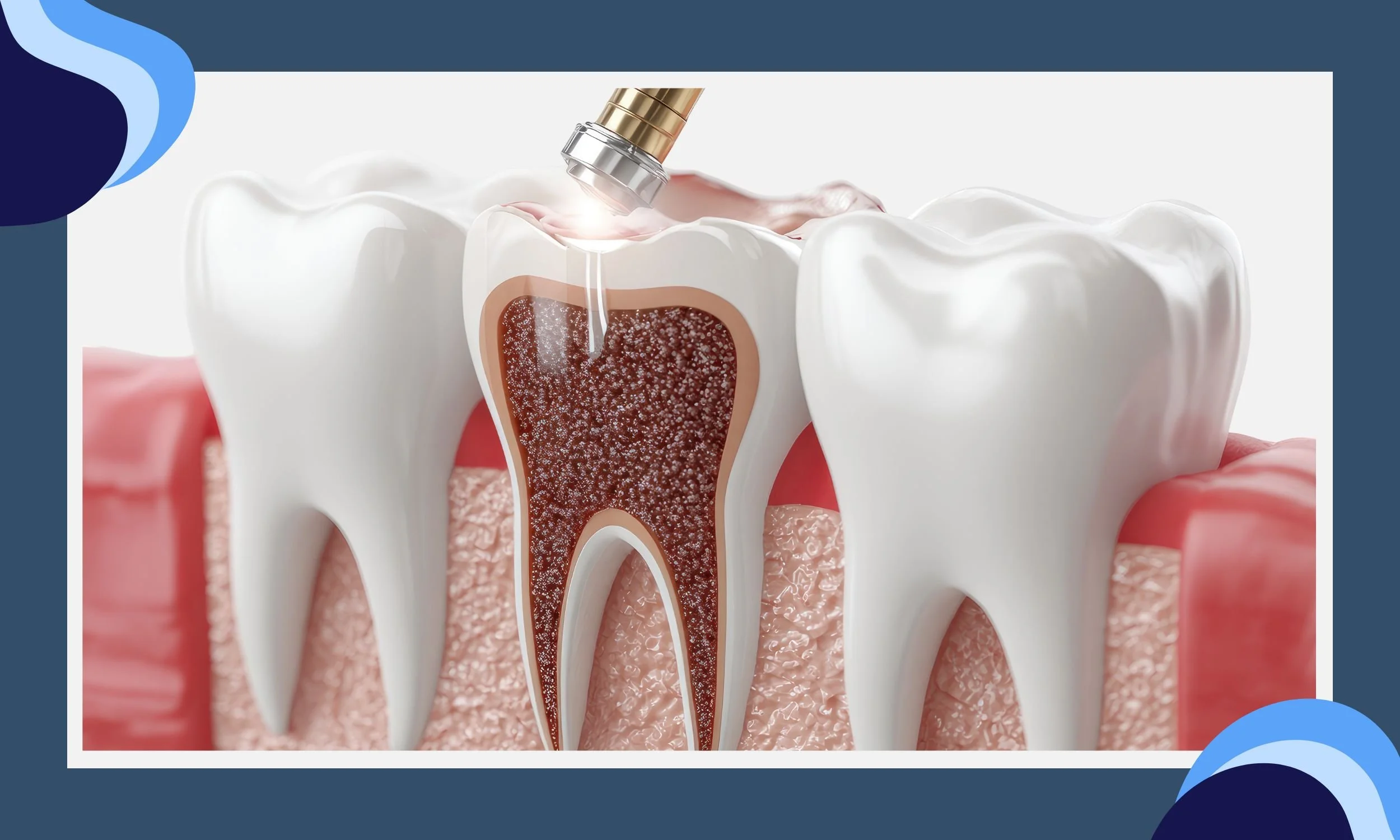 How Sealants Reduce the Risk of Cavities in Children