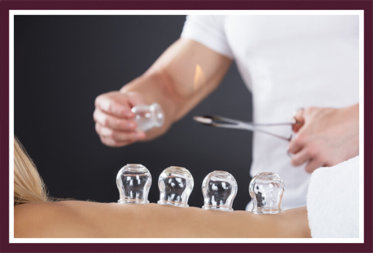 Cupping Therapy Near Lake Forest Northfield Glenview Winnetka Highland Park