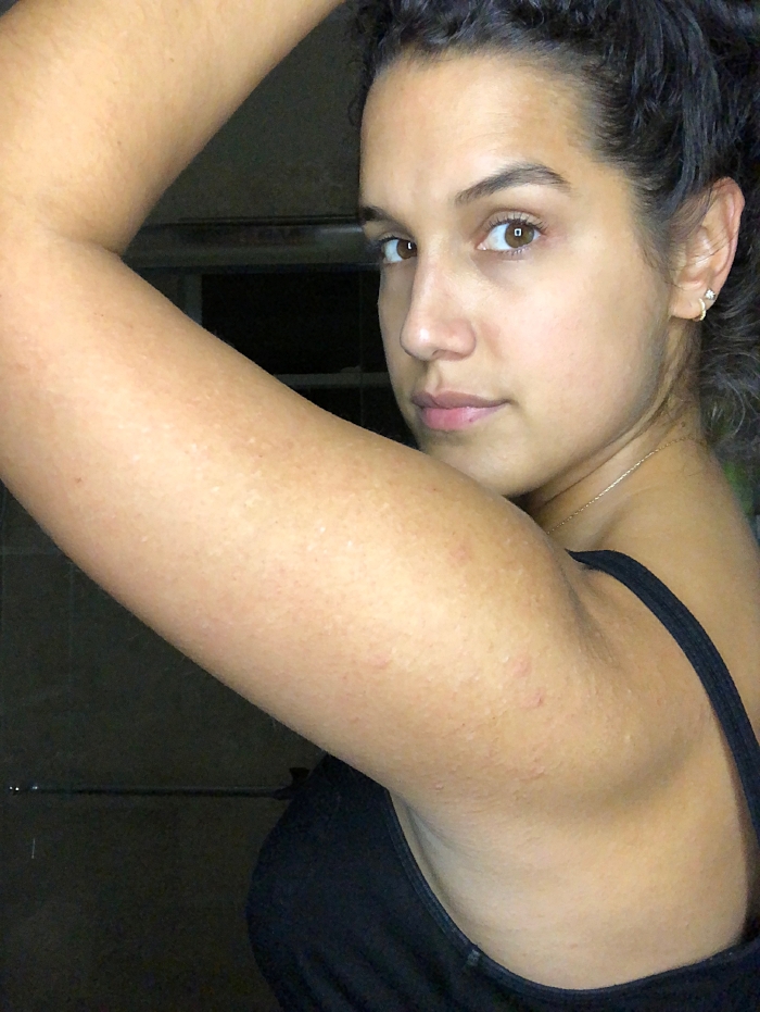 “CONFESSION: I’ve had KP on my arms since I was a teenager and I’ve also had anxiety since I was born. this lethal combo has led me to destroy my arms by way of picking at my KP. I have scarred myself beyond repair and hate my arms because of it. all those white dots you see? scars. I have crazy-defined triceps, but you can’t even tell through all the scarring. I envy the smooth, baby butt arms of girls and fantasize about what that must feel like; to not have to fight myself to not pick at it every day and never have to wear a jacket or long sleeves in the summer because yesterday’s “pick sesh” was particularly bad. I don’t like my arms and my anxiety is to blame.”