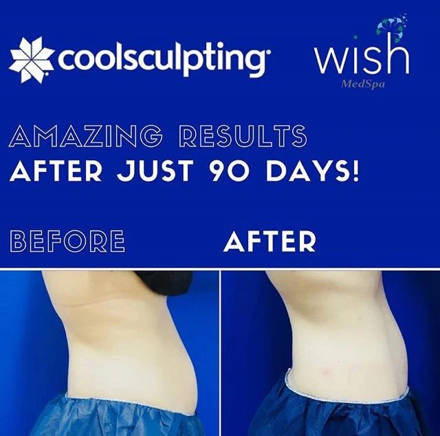 CoolSculpting® results after 90 days!