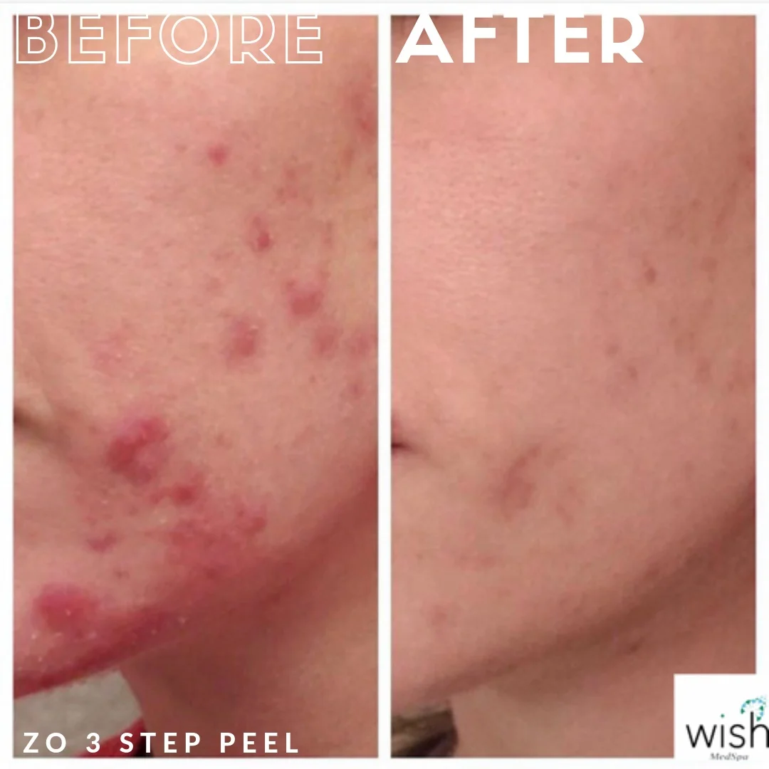 ZO 3 Step Peel Before & After 1.png
