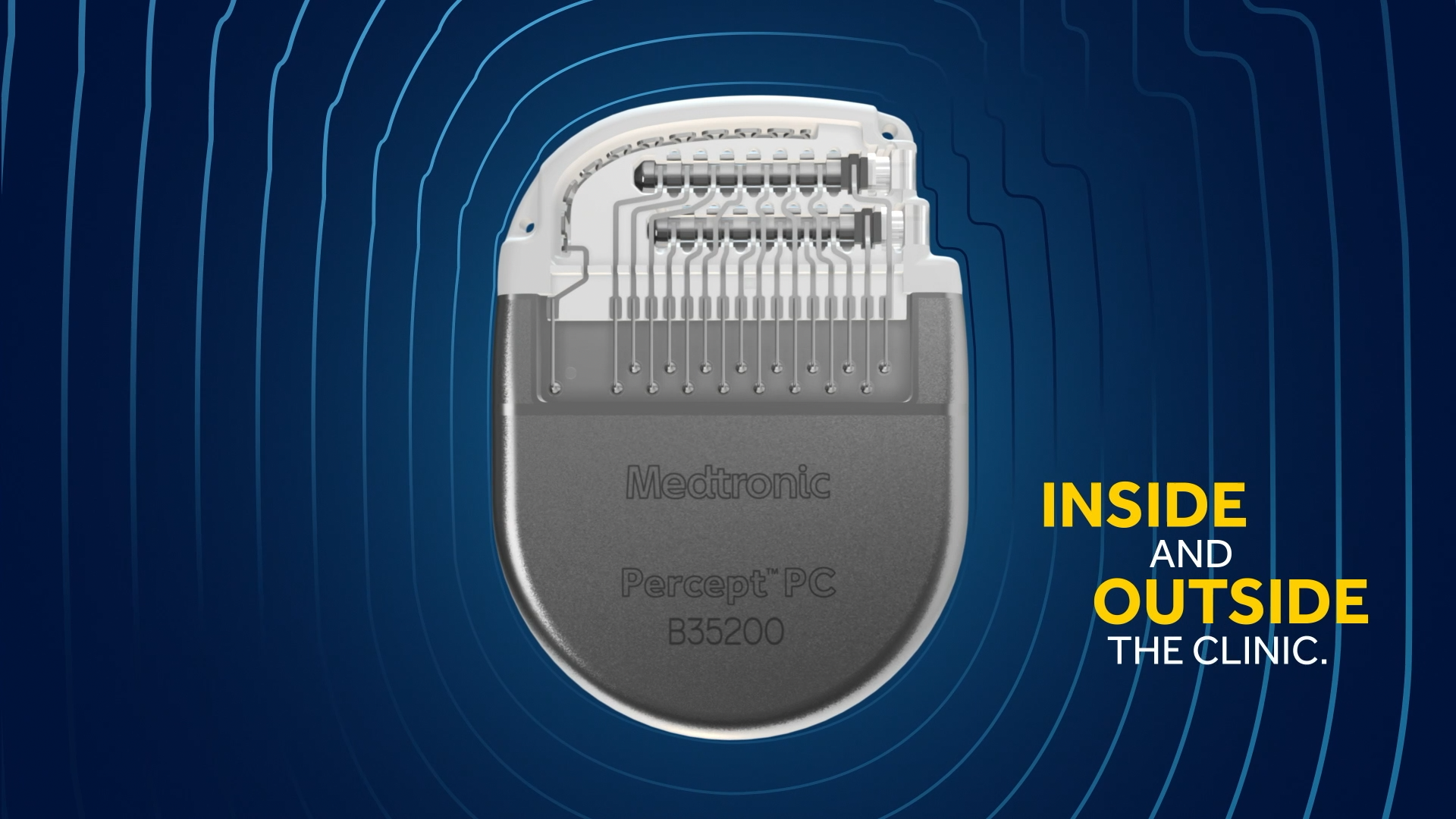 Medtronic - Precept DBS