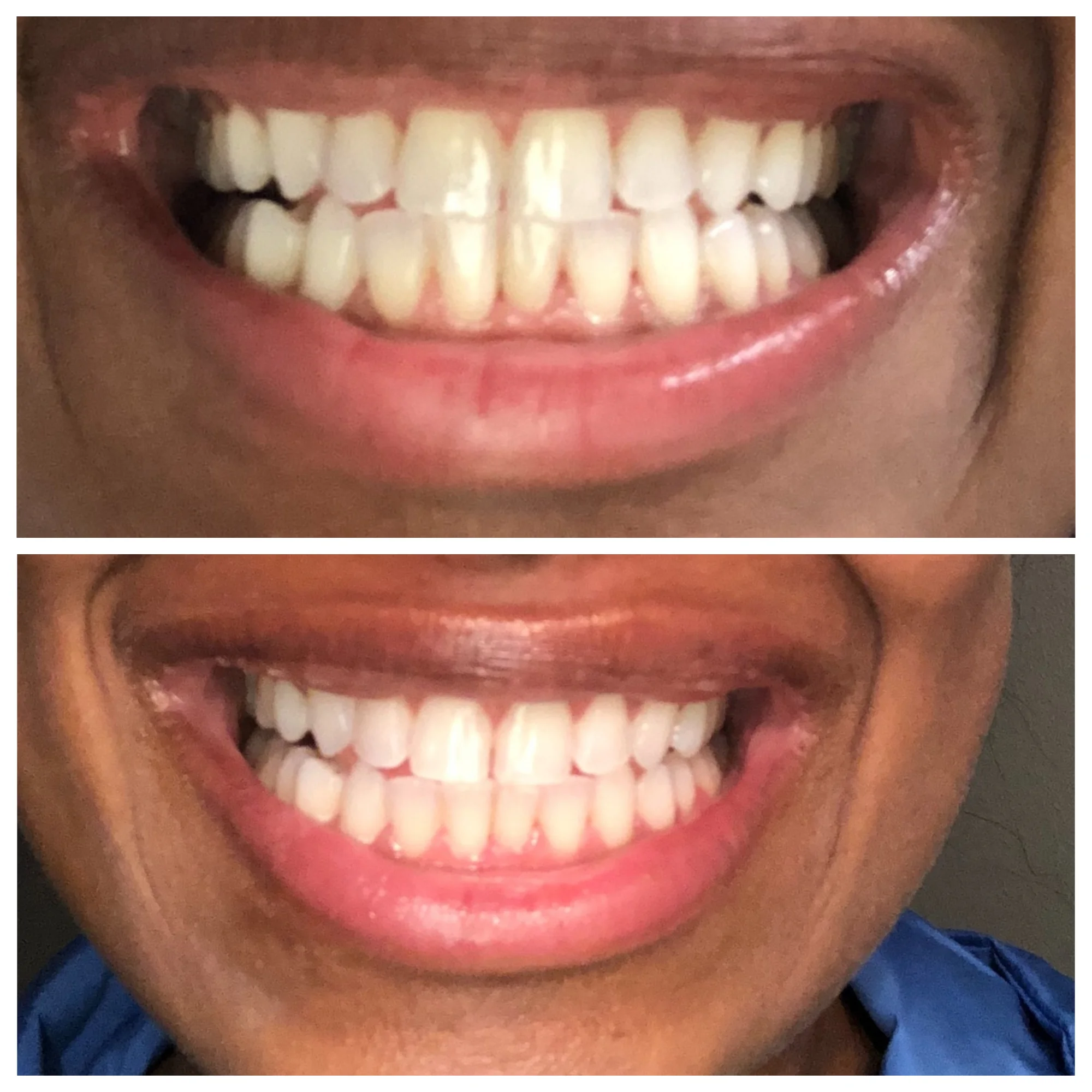Kayra Before-After stacked.jpg