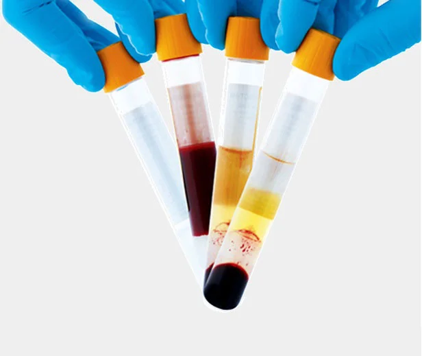 The yellow stuff is the plasma that makes PRP so effective!