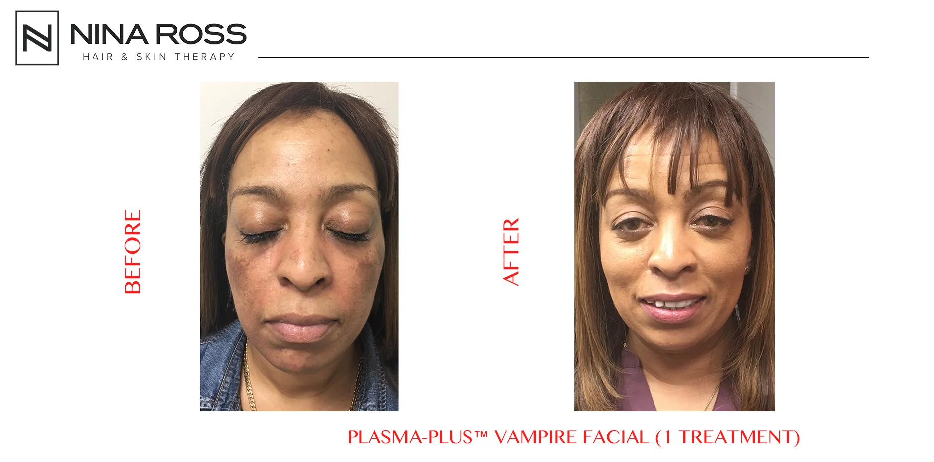 VampireFacial.jpg