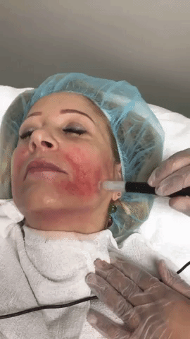 vampire facial.gif