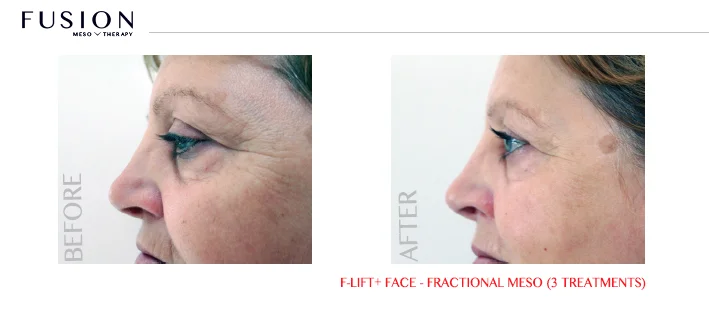 Fusion-BA-F-LiftFace-Fractional-Meso-3-treatments.jpg