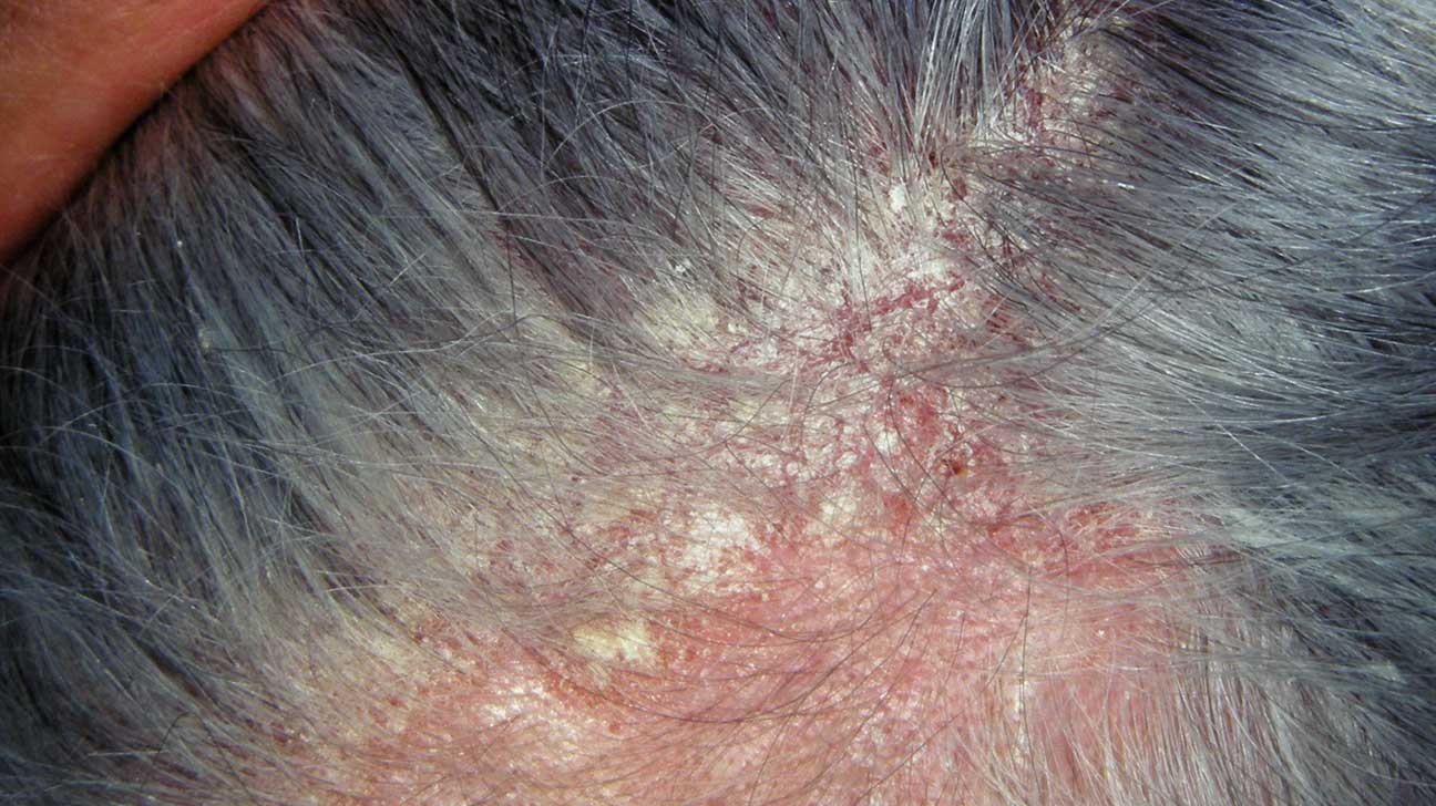 6012-Seborrheic_dermatitis_as_a_psoriasis_mimic-1296x728-slide6.jpg
