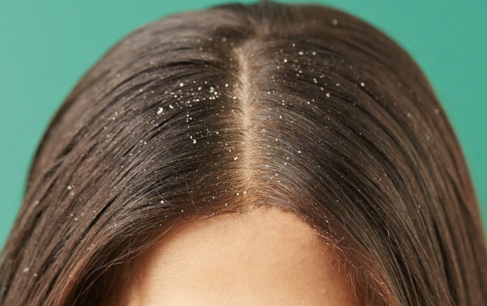 Scalp Issues | How To Identify The Symptoms?