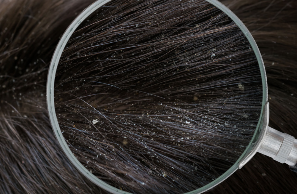 Does Excessive Oil Cause Harmful Build-Up On Your Scalp?