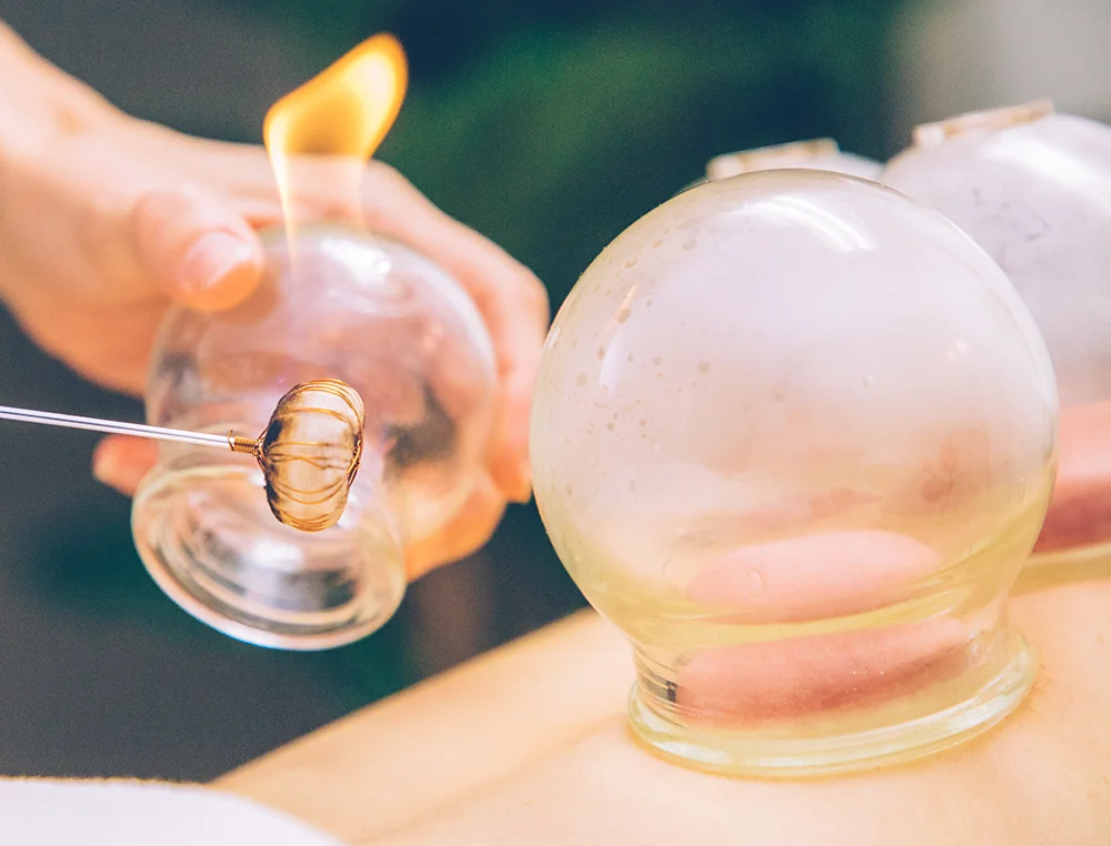 cupping-acupuncture.jpg