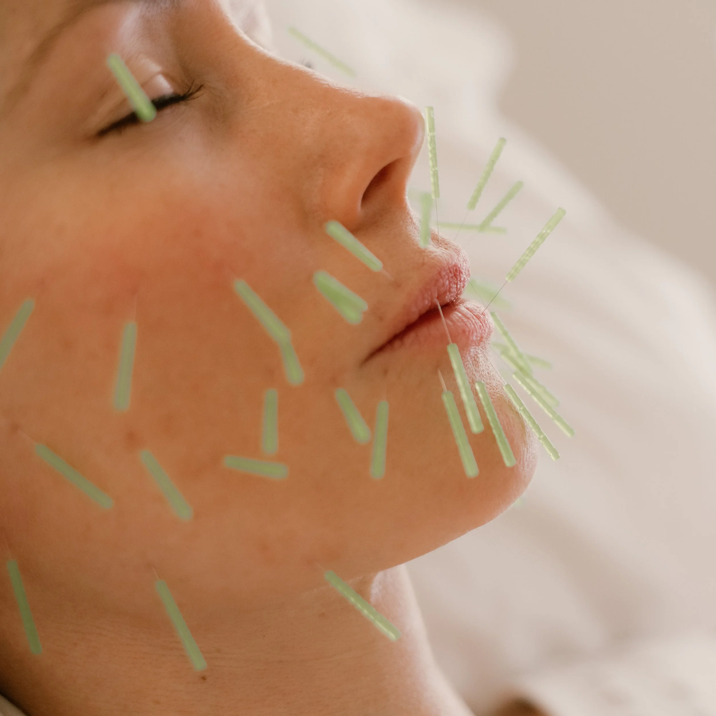 Acupuncture in Costa Mesa, Newport Beach & Orange County Magnolia