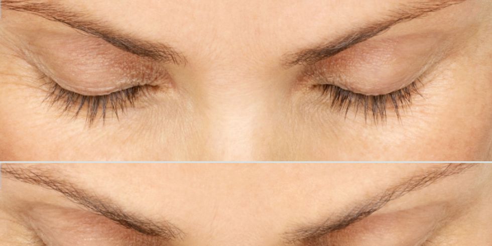 6 Things You Need to Know Before Trying Latisse