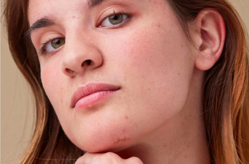 Celebrity Dermatologists Share How to Get Rid of Acne Scars Once and For All