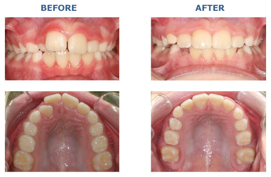 COMPREHENSIVE CLASS II OVERBITE OVERJET