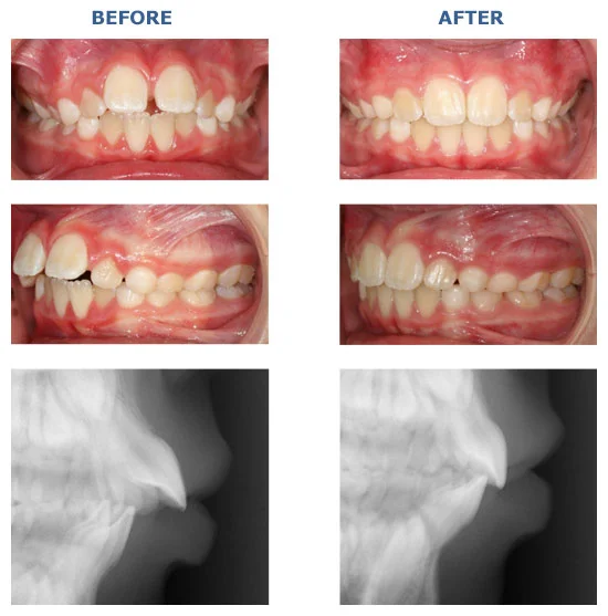 COMPREHENSIVE ANTERIOR CROSSBITE MIDLINE SHIFT
