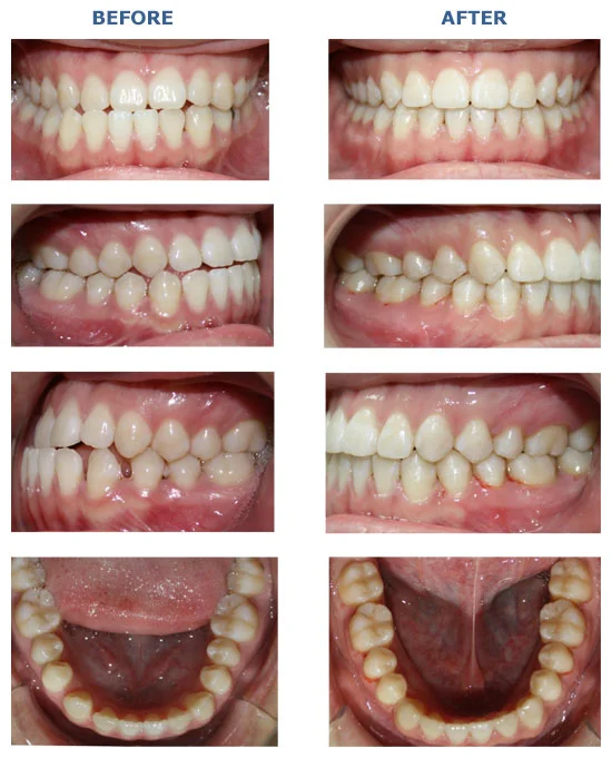 MOLAR UPRIGHTING