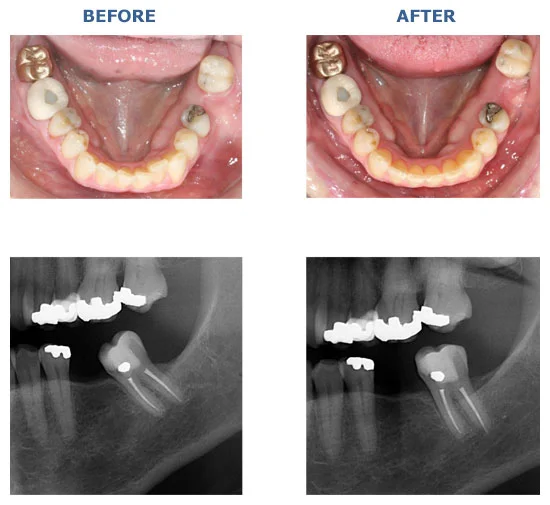 ANTERIOR CROSSBITE ONLY
