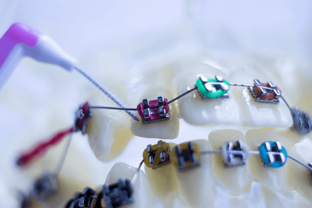 Interdental brushes can really help cleaning your metal braces by cleaning plaque off the metal parts.