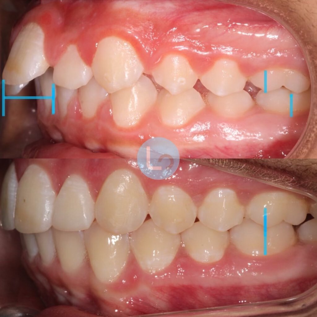 👏 LOOK 👏 AT 👏 THIS 👏 TRANSFORMATION 👏 Happy #transformationtuesday 🔥 Priya&rsquo;s new smile is contagious 😁
&bull;
✅ symmetric
✅ functional
✅ confident
✅ healthy
&bull;
A few of the corrections that go into Dr. Lombard&rsquo;s results are hig