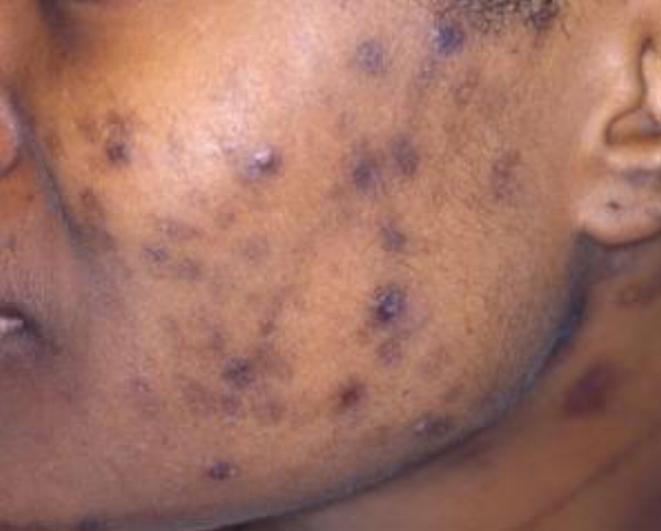 Post Inflammatory Hyperpigmentation — Black Skin Directory