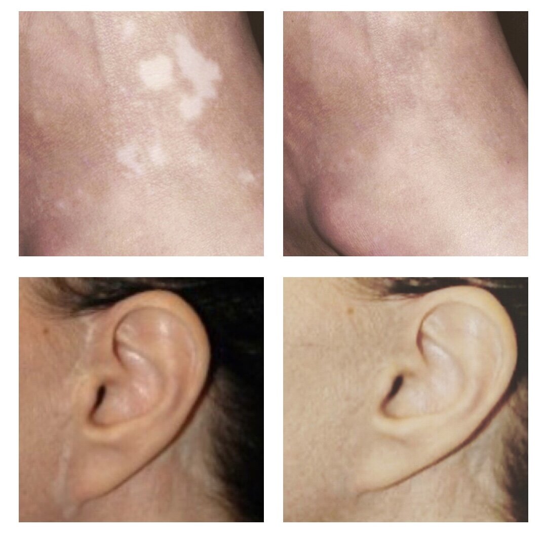 VITILIGO,JAZVA PO FACELIFTINGU