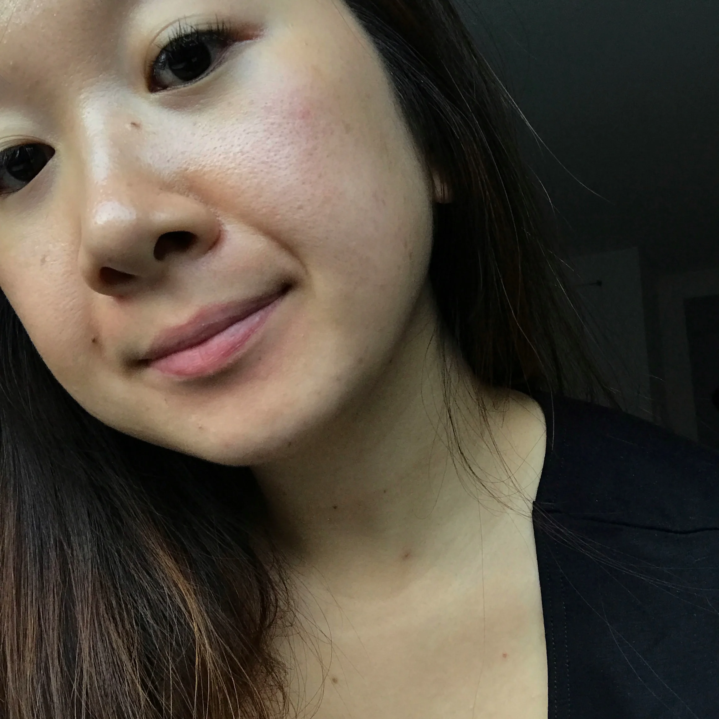 Before | Old acne scars were still visible around my chin area. (Photo unedited; taken facing natural daylight.)