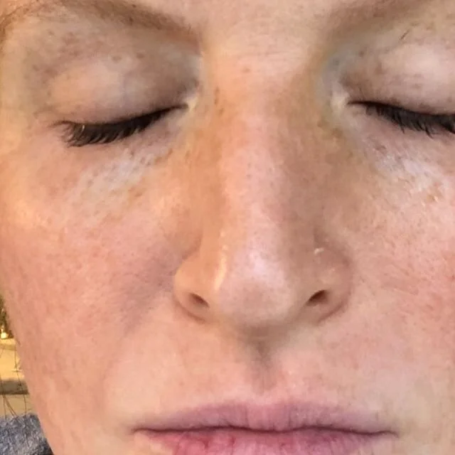 Sorry I missed yesterday... you know how it is these days...so the crazy peeling has stopped, now my skin just feels kind of rough and it&rsquo;s still pink... but someone who didn&rsquo;t know what I looked like before probably wouldn&rsquo;t notice