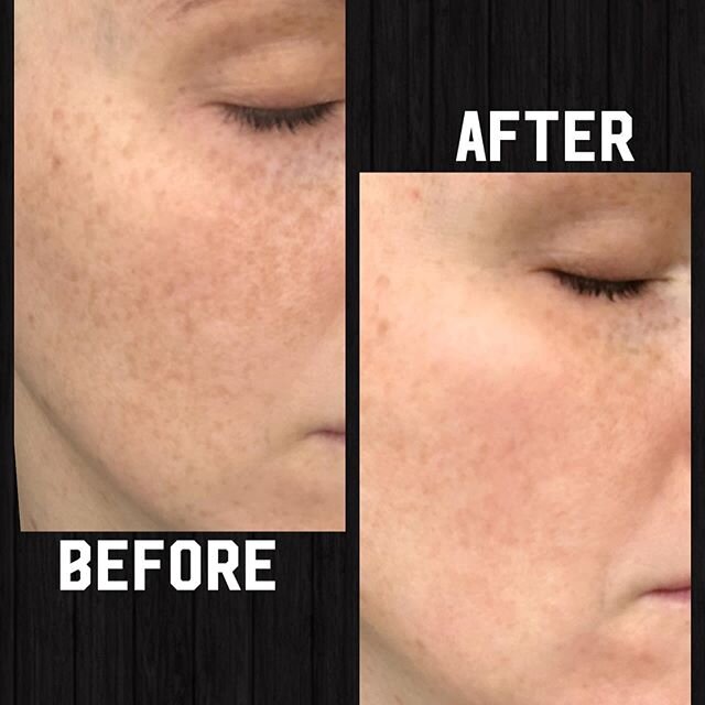 Hi everyone! So this after picture was from a few days ago ...since then I restarted the post peel regimen which makes my skin a little redder and dryer again but also continues to improve the results ...so I&rsquo;ll post again in a few days ....but
