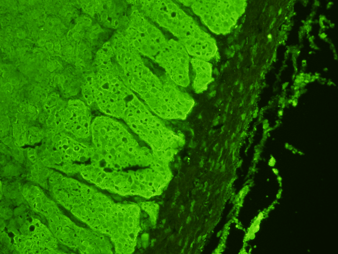  Adrenal Antibody Test Kit  Indirect Immunofluoresence assay for the detection of Adrenal cortex antibodies &nbsp;in human serum on primate adrenal gland sections. &nbsp;Adrenal antibodies are associated with the idopathic form of Addison's Disease. 