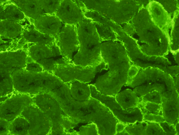  Reticulin IgA Antibody Test Kit  Indirect Immunofluorescence assay for the detection of Reticulin IgA antibodies in human serum on rat liver/kidney/stomach sections. &nbsp;These antibodies react to the Reticulin antigens most frequently associated w