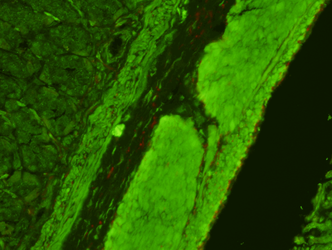  Smooth Muscle Antibody Test Kit  Indirect Immunofluorescence Assay for the detection of Smooth Muscle antibodies in human serum on rat stomach sections. &nbsp;SMA can be demonstrated in patients with acute and chronic hepatitis: the highest titers o