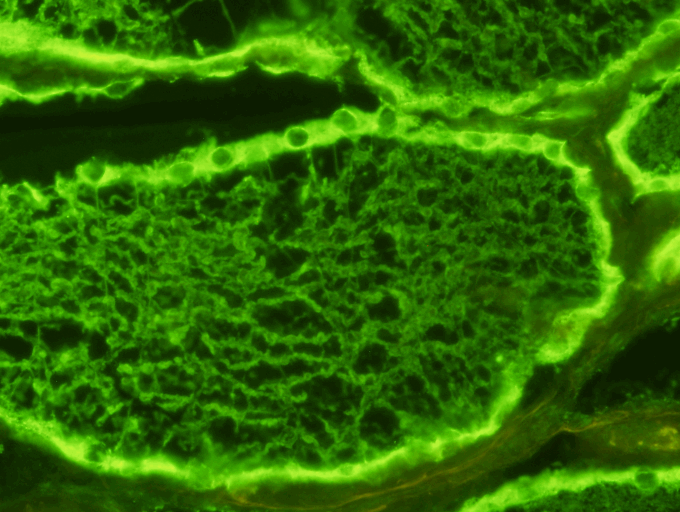  Thyroid Antibody Test Kit  Indirect Immunofluorescence Assay for the detection of all thyroid autoantibodies and as a quantitative test for microsomal antibody in human serum on primate thyroid sections. The detection of thyroid antibodies is import