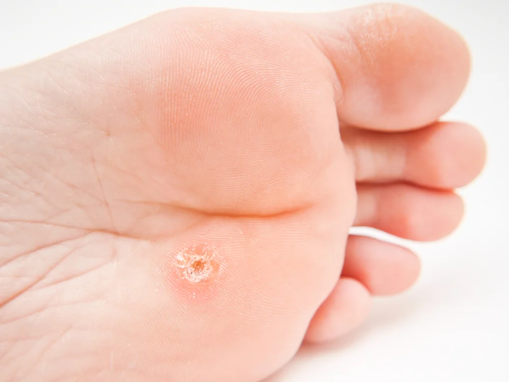 foot wart treatment removal plantar wart fairfax va