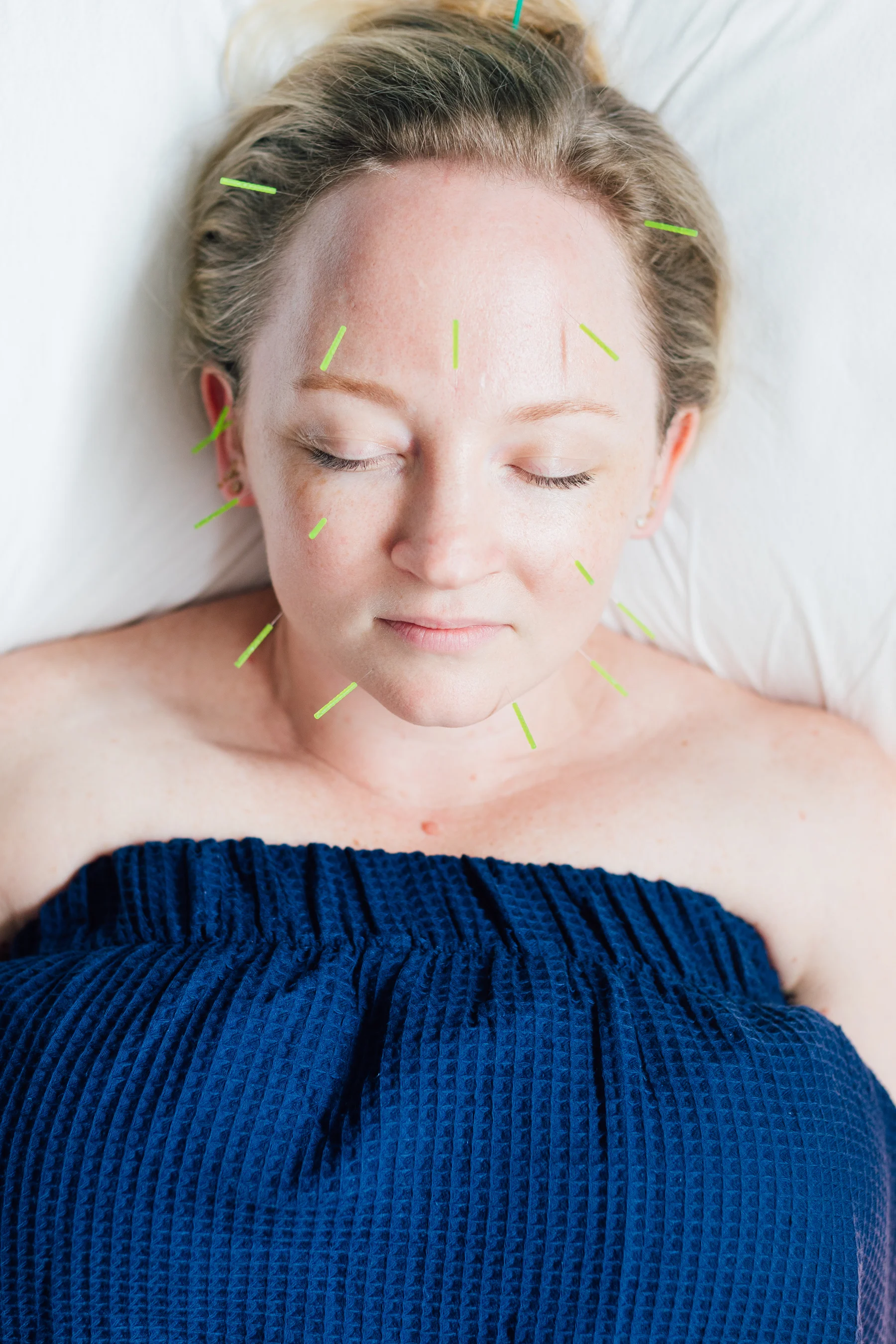 Facial Acupuncture, Aculuxe, Indigo, Guasha, Gua Sha