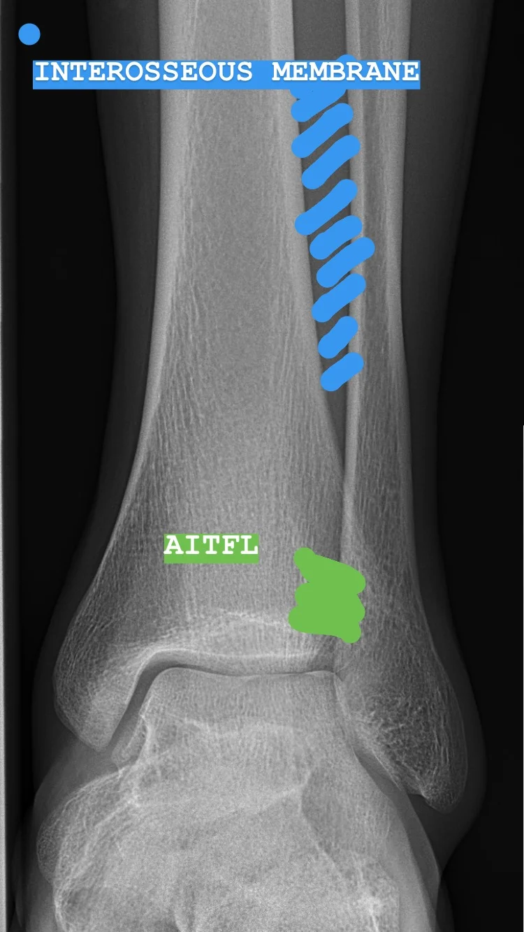 FLOW PHYSIO CO FLOW KNOWS Syndesmosis Injury High Ankle Sprains