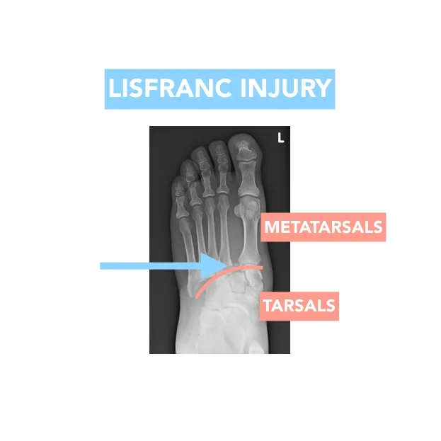 LISFRANC JPG.001.jpeg