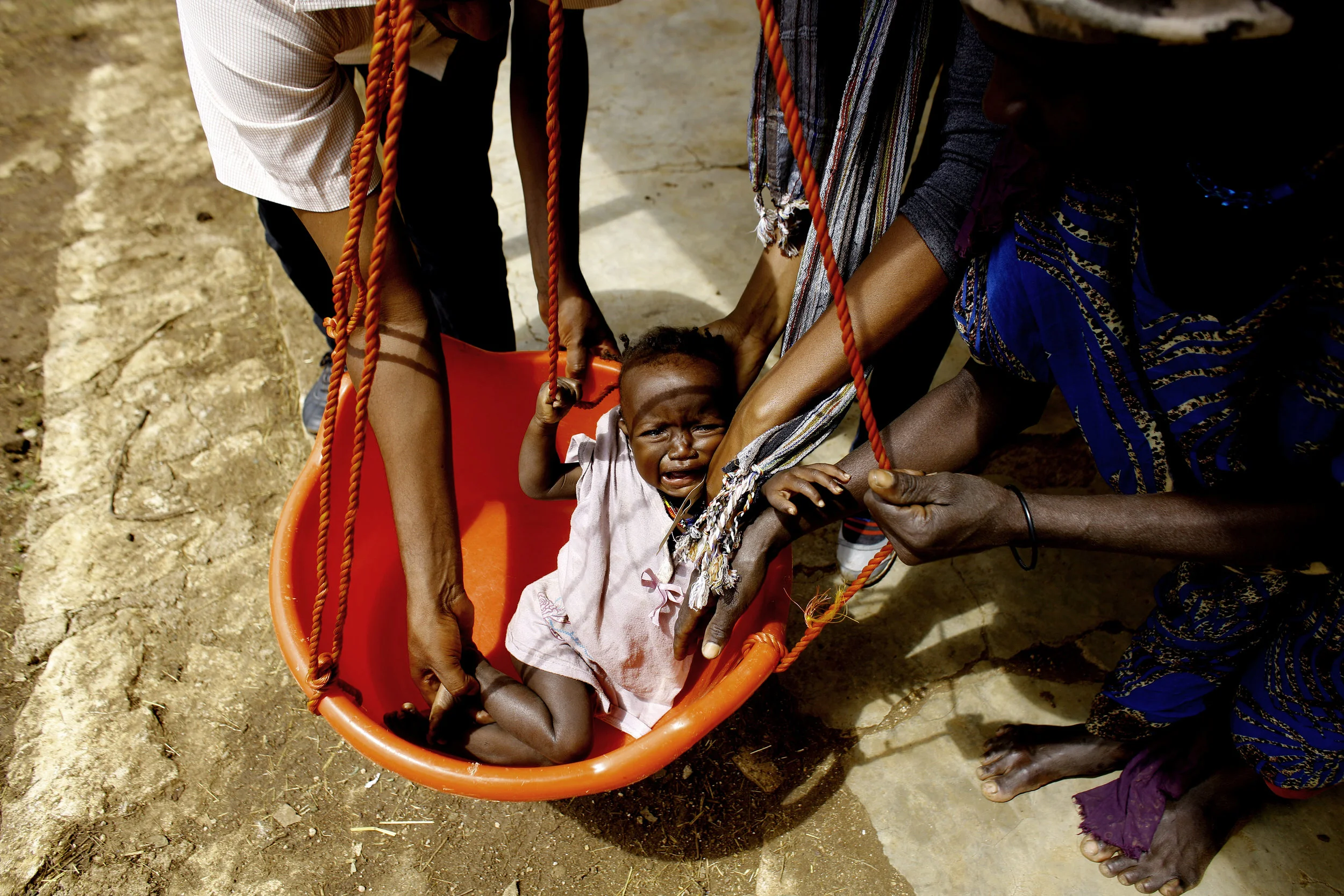 A severely malnourished child cries while being weight at a health clinic in Ethiopia, a result of a long term drought.