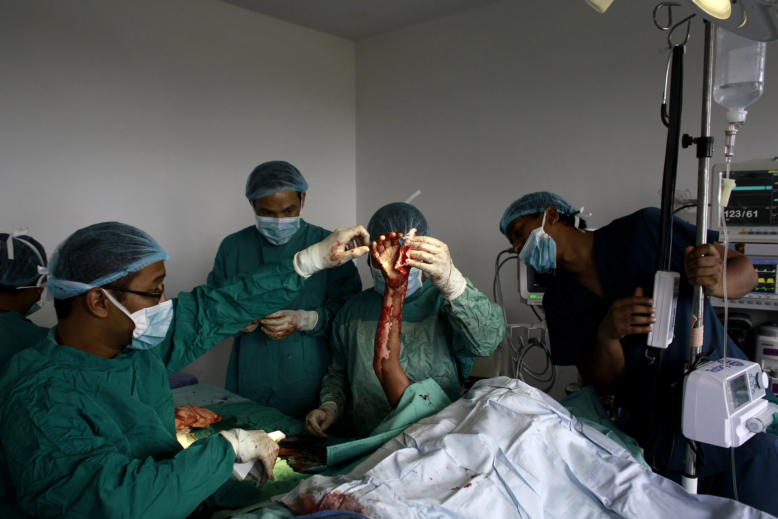 Doctors with ReSurge perform skin grafts on a patient who sustained serious burns - Nepal