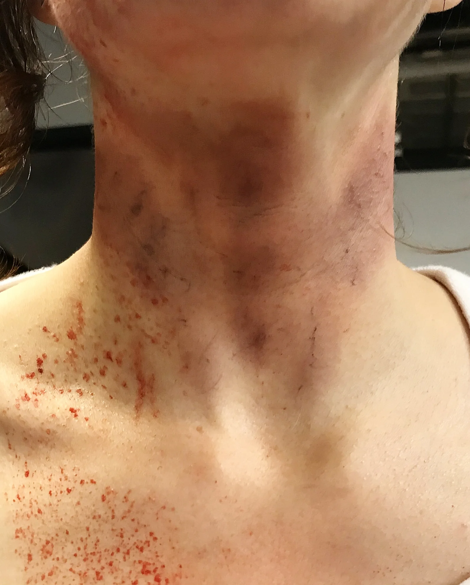 Postmortem Strangulation