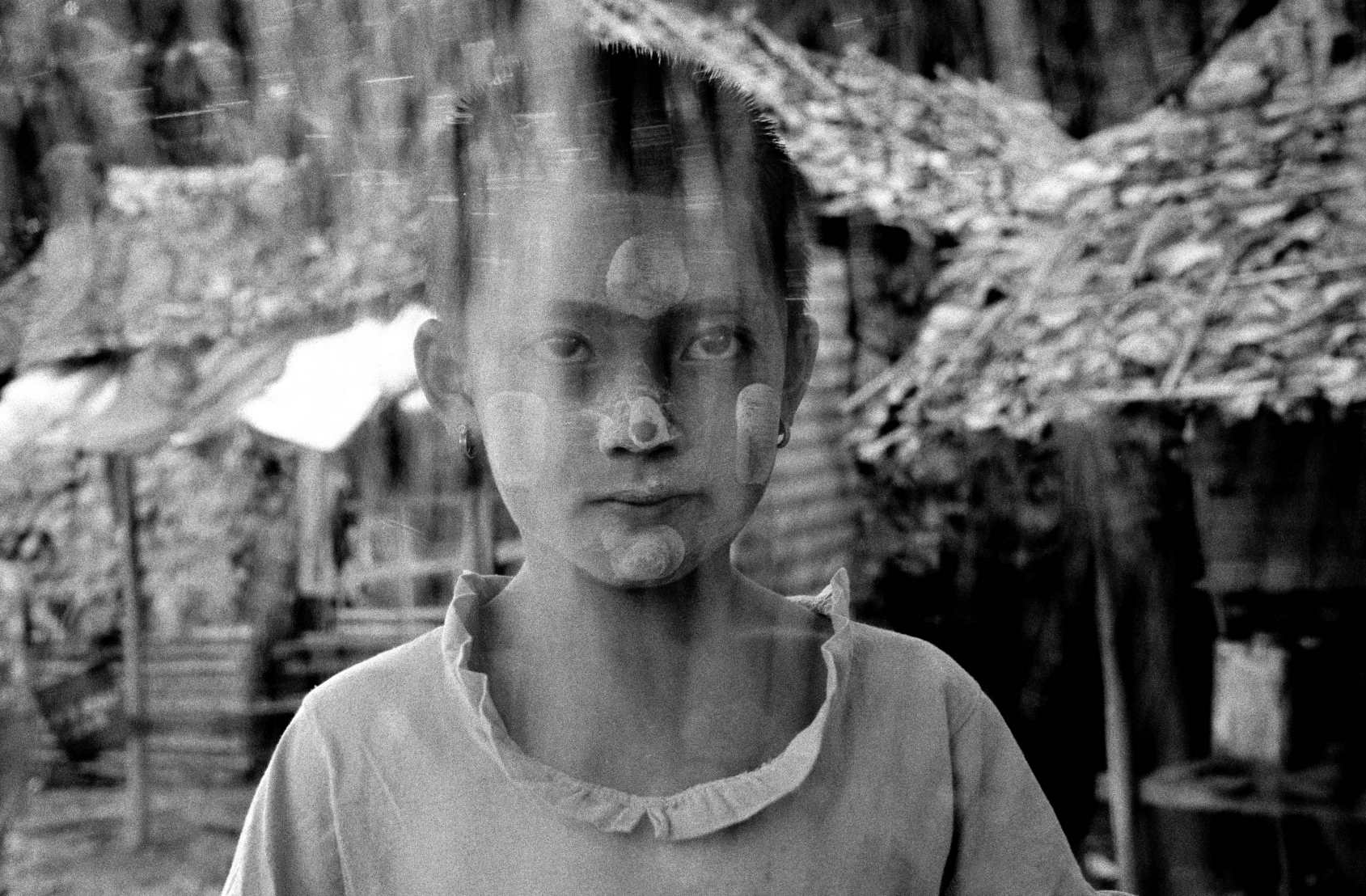  Malnourished. Mae Sot, Thailand. 2001 