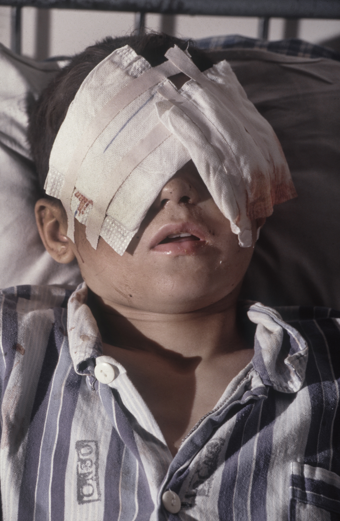  Sead Bekric in a hospital in Tuzla, Bosnia-Herzegovina, after Serb fire blinded him in the Muslim held enclave of Srebrenica. 1993 