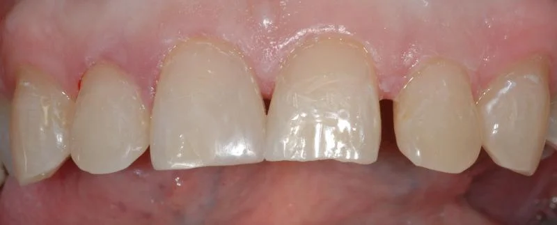New white composite fillings