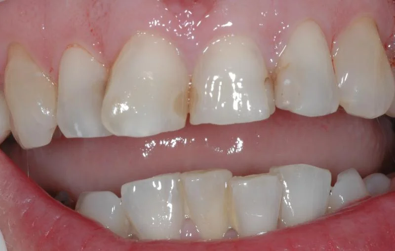 Discoloured old composite fillings.