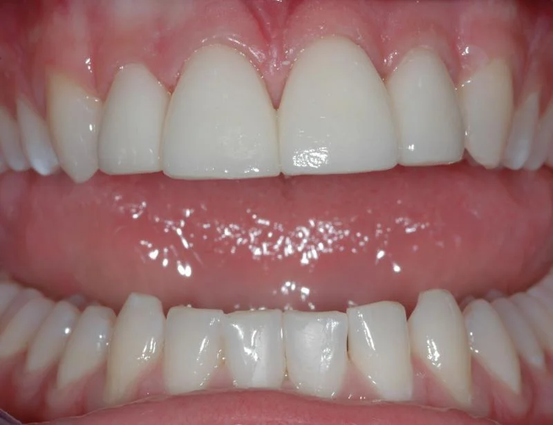 Four porcelain veneers and composite fillings to close spaces, lengthen and straighten teeth.