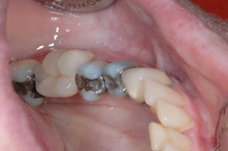 Old failing amalgam fillings.