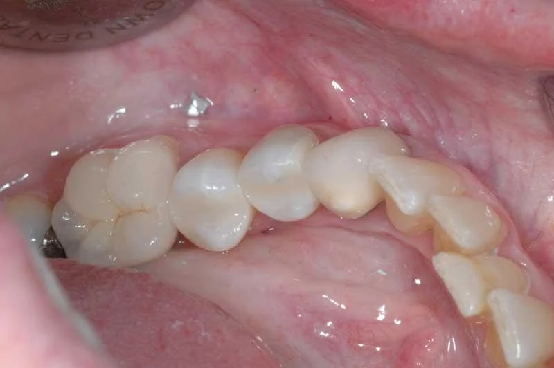 New composite fillings